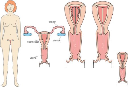 Spiraaltje (IUD)